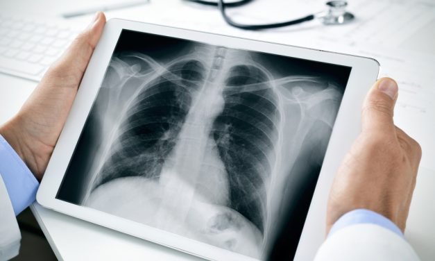 HM Hospitales impulsa el programa de detección precoz de cáncer de pulmón