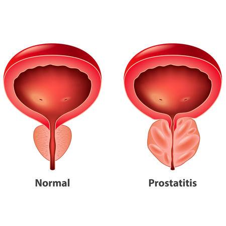 Prostatitis prostata inflamada - Próstata inflamada ¿Síntoma de alarma?