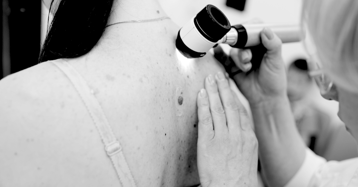 El dermatólogo examina los moles o acné del paciente con un dermatoscopio. Prevención del melanoma