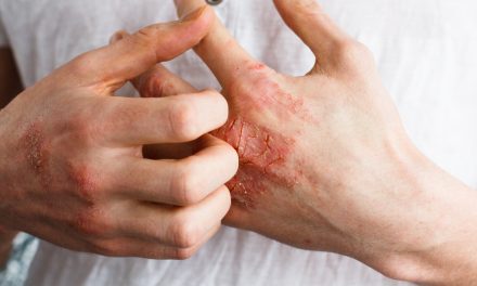 Día Mundial de la Psoriasis: Encuesta NEXT, la enfermedad en datos