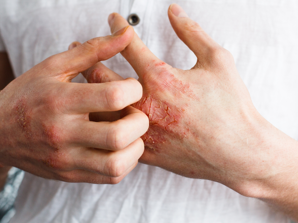 psoriasis