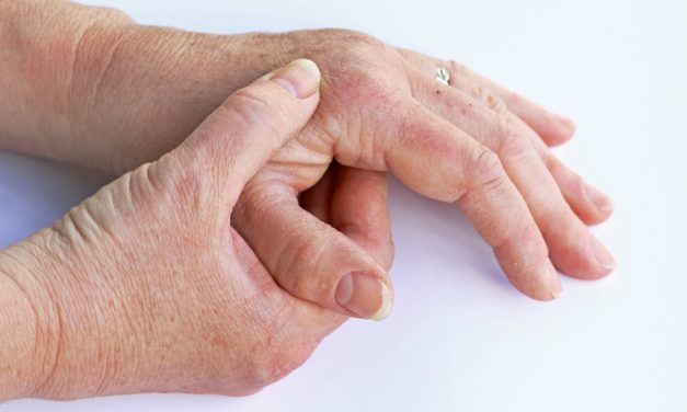 La posible desfinanciación de un medicamento para la artrosis afectaría a miles de pacientes, advierten desde la Fundación Española de Reumatología