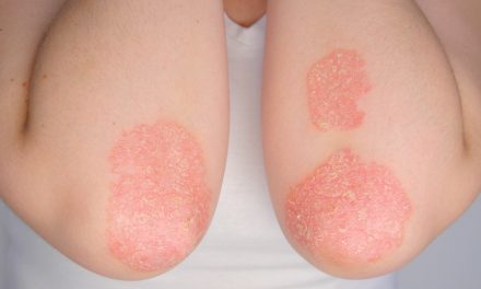 Acción Psoriasis reclama al gobierno de La Rioja, mejor abordaje de la enfermedad