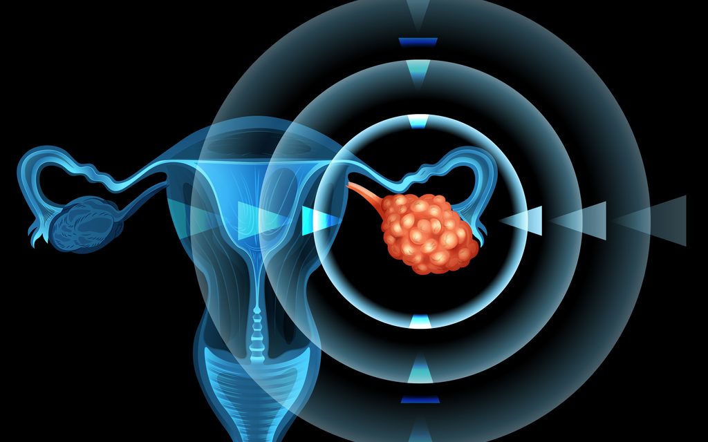 «Los tratamientos previstos para las pacientes de Cáncer de Ovario han seguido llevándose a cabo»