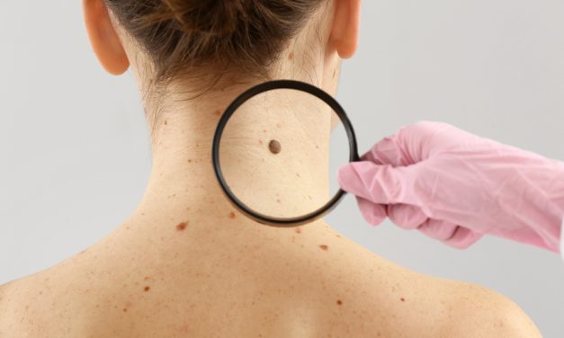 Más del 90% de los cánceres de piel se pueden evitar