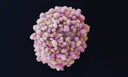 El diagnóstico por imagen es la forma más eficaz de detectar precozmente el cáncer de mama