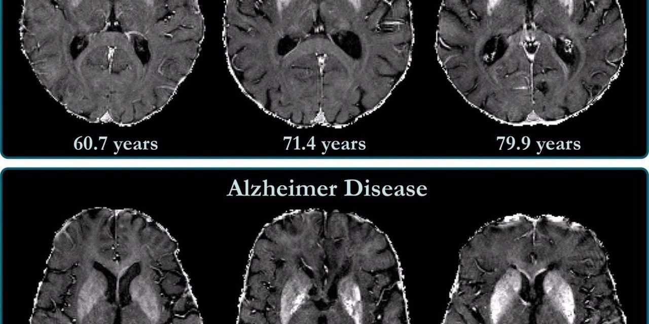 IBM y Pfizer desarrollan un modelo de IA capaz de predecir la aparición de Alzheimer en personas sanas