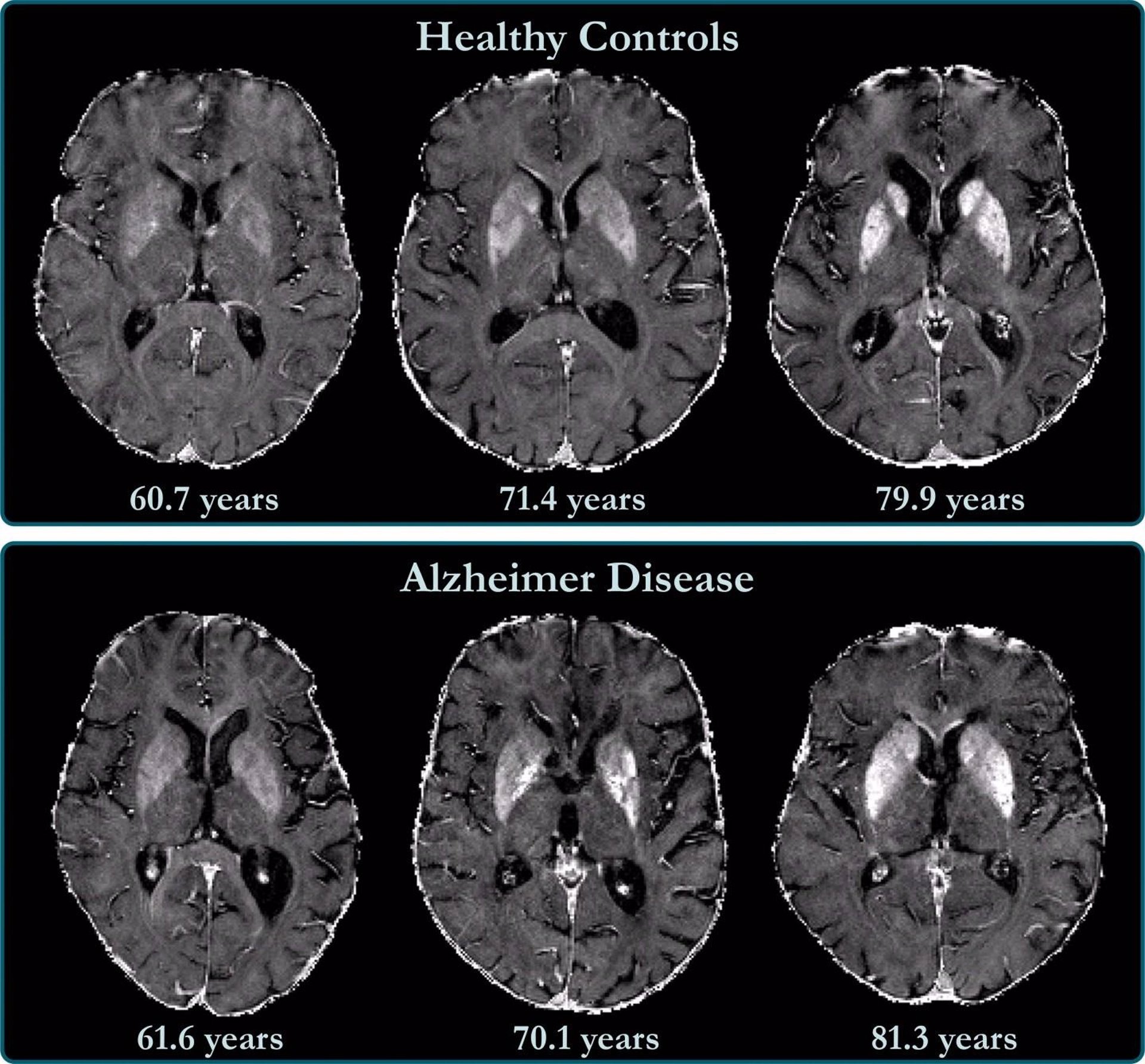 alzheimer inteligencia artificial