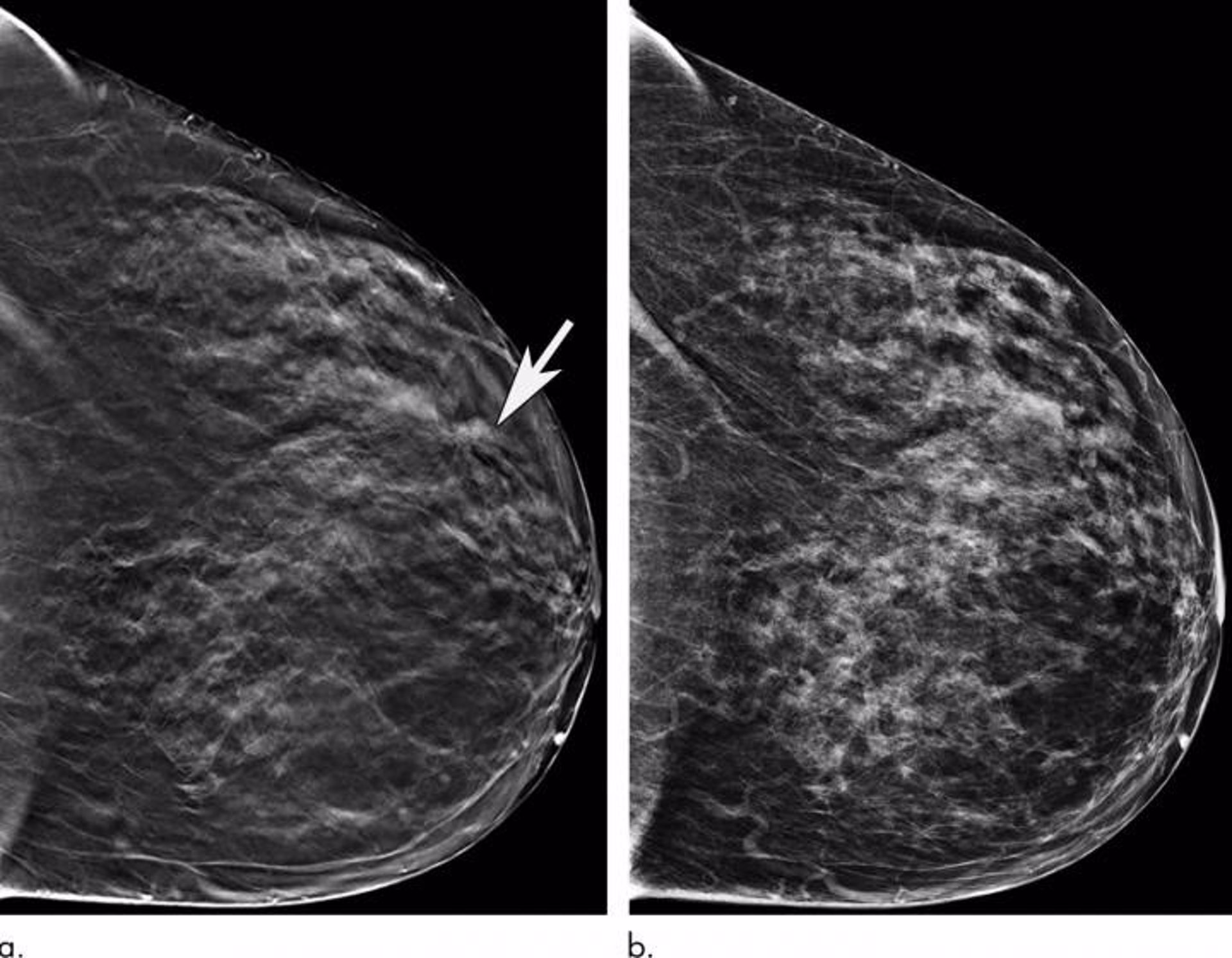 Маммография в московском. Маммография. Маммография молочных желез. Инфрамаммарная складка на маммограмме. Полиакриламидный гель в молочных железах маммография.