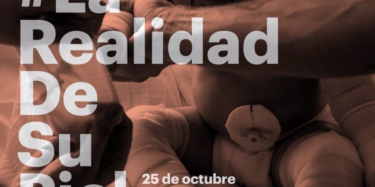 DEBRA Piel de Mariposa anuncia la pérdida del 80% de ingresos, lo que afectaría a la atención de pacientes