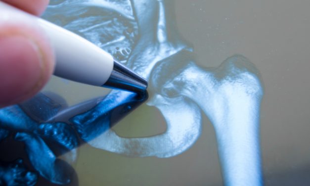 Siete de cada 1.000 habitantes mayores de 65 años en España sufren fractura de cadera