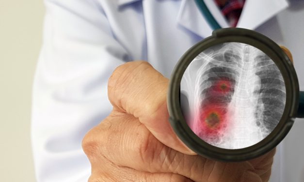 La vacunación en pacientes adultos es clave para prevenir la neumonía no asociada a la COVID-19