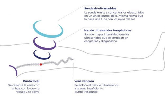 Nuevo tratamiento no invasivo para las varices