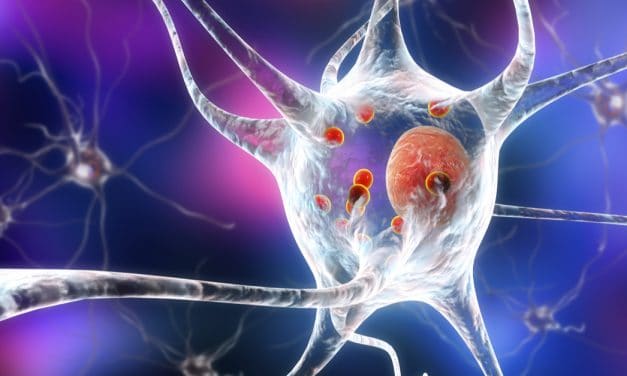 La estimulación cerebral profunda ayuda a mejorar síntomas del Parkinson como la distonía y el temblor esencial