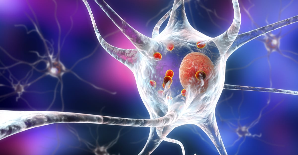 La estimulación cerebral profunda ayuda a mejorar síntomas del Parkinson como la distonía y el temblor esencial