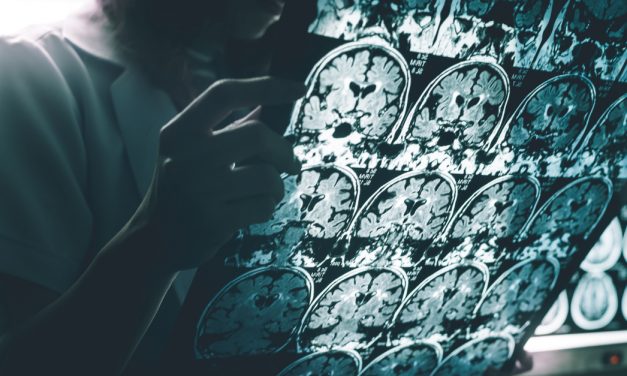 Mantener el cerebro activo puede retrasar la demencia de Alzheimer 5 años