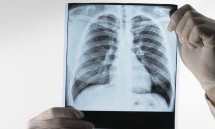 La inteligencia artificial podría ayudar a diagnosticar el cáncer de pulmón un año antes
