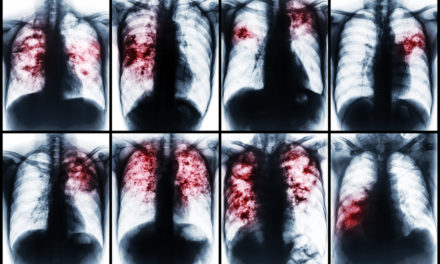 El ECDC y la OMS advierten de un «fuerte descenso» en los casos de tuberculosis en Europa por el impacto de la pandemia