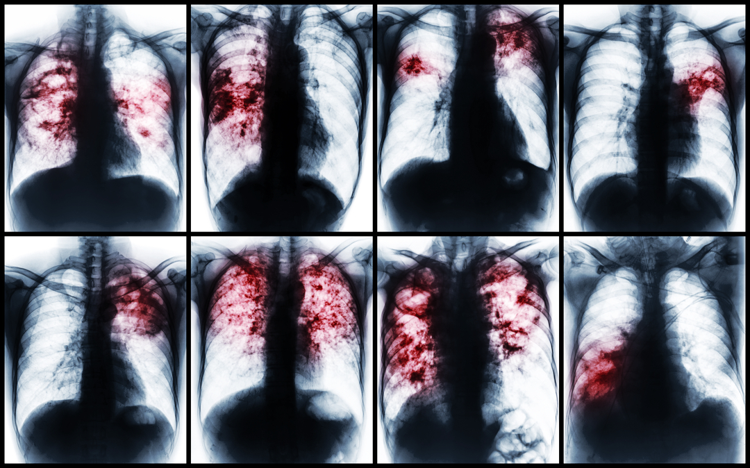 Colección de tuberculosis pulmonar . Los rayos X muestran infiltración irregular , infiltración intersticial , infiltración alveolar , cavidad , fibrosis pulmonar debida a la infección por Mycobacterium tuberculosis .