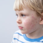 La dermatomiositis juvenil (DMJ) requiere un tratamiento multidisciplinar
