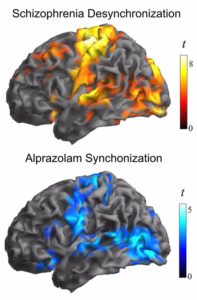 esquizofrenia zonas afectadas cerebro 197x300 - Un estudio descubre un defecto en las neuronas de las personas con esquizofrenia