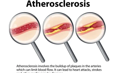 La aterosclerosis aumenta el riesgo de sufrir un ictus o un ataque cardíaco en personas con diabetes tipo 2