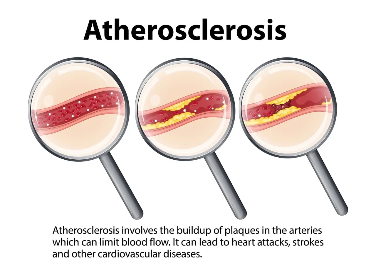 ateroesclerosis-desarrollo