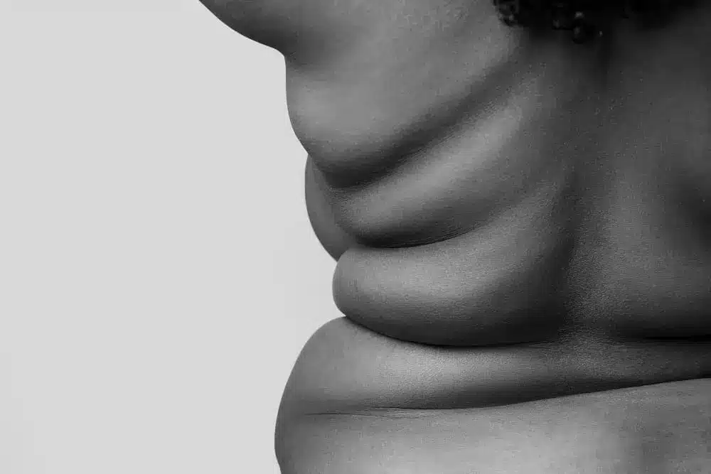 jornada obesidad Día Mundial de la Obesidad jornada obesidad Día Mundial de la Obesidad